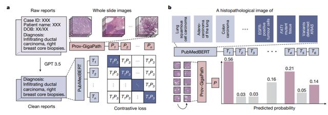 AI病理学大模型革新癌症诊断,科学家揭秘技术突破
