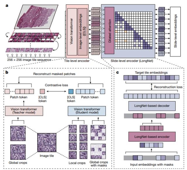 AI病理学大模型革新癌症诊断,科学家揭秘技术突破